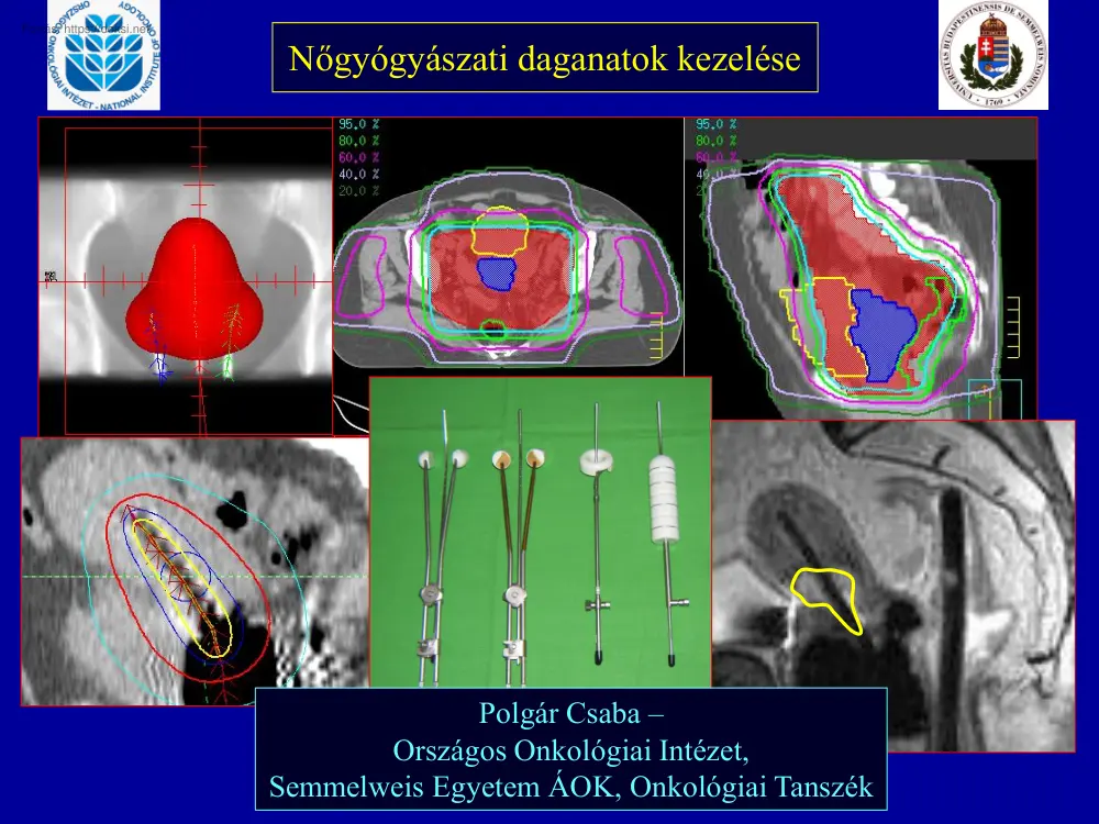 Polgár Csaba - Nőgyógyászati daganatok kezelése