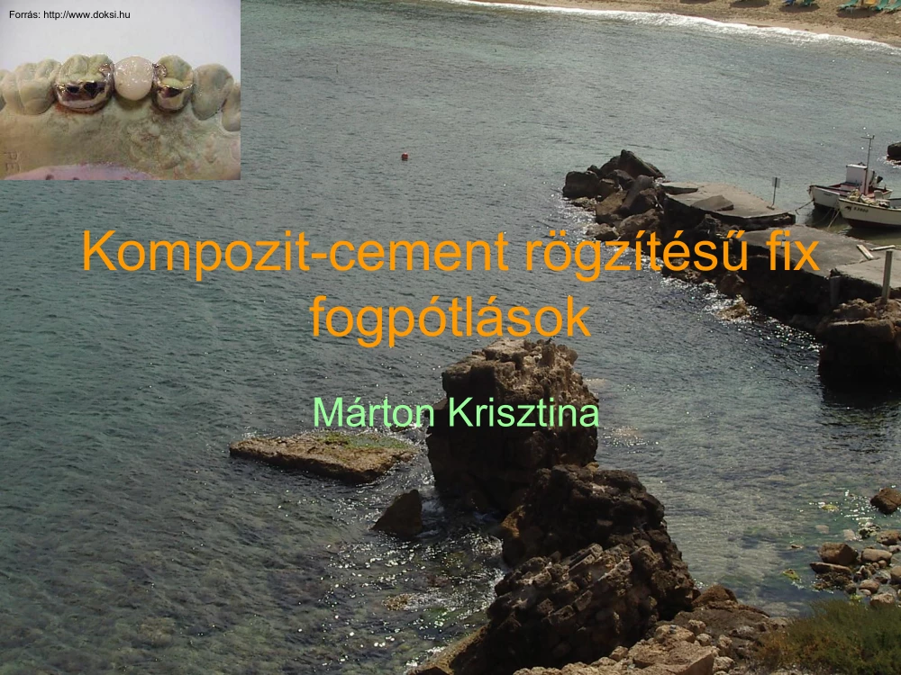 Dr. Márton Krisztina - Kompozit-cement rögzítésű fix fogpótlások